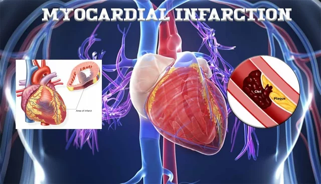 The Role of Biosoprolol in Post-Myocardial Infarction Care